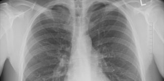 Four important things everyone should know about lung cancer screening during Lung Cancer Awareness Month lung cancer screening