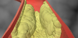 Testing for calcium in the coronary arteries provides better way to predict heart attacks than stress testing alone PET/CT testing on coronary arteries can show the level of coronary artery calcium buildup, which is a predictor of heart attacks.